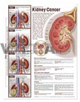 Understanding Kidney Cancer Anatomical Chart